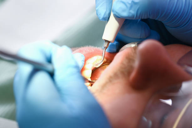 Best Emergency Wisdom Teeth Removal in West Ishpeng, MI